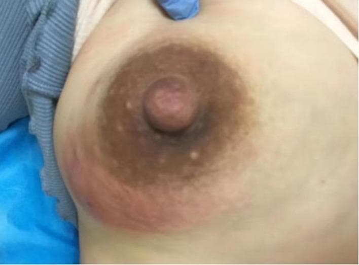 A clinical photograph of a right breast exhibiting signs of acute inflammation, specifically related to acute lactation mastitis (ALM). The lower-inner quadrant demonstrates a significant area of erythema (redness) and localized edema (swelling). This erythematous lesion extends toward the periareolar region. The areola appears hyperpigmented and displays prominent Montgomery tubercles (small, raised sebaceous glands). The nipple is slightly swollen with a reddish hue and an irregular surface texture. The clinical presentation is consistent with a breast abscess or inflammatory mastitis during the postpartum period. This image serves as an educational tool for identifying primary clinical manifestations of infectious breast disease, such as redness, swelling, and localized inflammatory changes in a lactating patient.