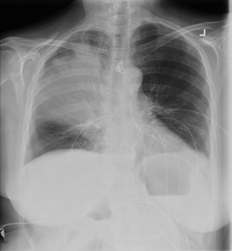 This anterior-posterior (AP) chest radiograph displays a prominent area of heterogeneous opacity and consolidation localized to the right upper lobe. The consolidation is characterized by increased radiodensity with ill-defined margins, indicative of lobar pneumonia, specifically associated here with Legionella pneumophila infection. In contrast, the left lung field remains relatively clear with normal bronchovascular markings. Visible medical interventions include a central venous catheter projecting over the superior mediastinum and multiple external monitor leads traversing the thoracic and upper abdominal regions. The cardiac silhouette and diaphragmatic contours are visible, though partially obscured on the right side by the overlying consolidation. This imaging provides a classic example of acute bacterial pneumonia in an adult patient, demonstrating clear lobar involvement and the presence of clinical support apparatus common in acute care settings.