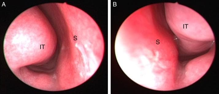 This diagnostic image consists of two rigid nasal endoscopy frames (A and B) illustrating the internal anatomy of the right and left nasal cavities in a 14-year-old male. In panel A (right side), the inferior turbinate (IT) is visible as a smooth, rounded, pinkish structure extending from the lateral wall toward the medial nasal septum (S), maintaining a patent airway passage. In panel B (left side), there is marked hypertrophy of the left inferior turbinate (IT). This structure is significantly enlarged compared to the contralateral side, narrowing the nasal passage and making close contact with the nasal septum (S). The mucosa of the turbinates in both views appears pink and smooth, without evident purulent discharge or polyps. The anatomical labels 'S' for nasal septum and 'IT' for inferior turbinate identify the primary structures. The clinical significance of this finding is the evaluation of nasal obstruction, where such hypertrophy can be associated with concha bullosa or inferior turbinate pneumatization, as seen in this clinical case.