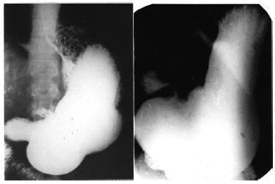 This diagnostic image consists of two side-by-side contrast-enhanced X-ray radiographs (barium swallow/upper GI series) illustrating clinical features of von Presser syndrome. Both cases demonstrate massive gastric dilatation (gastromegaly) involving the fundus and body, with a markedly elongated greater curvature occupying a significant portion of the abdominal cavity. A key diagnostic feature visible in both images is a distinct gastric ulcer located at the lesser curvature, specifically at the incisura angularis. This is characterized by a radiopaque niche or barium-filled outpouching projecting beyond the normal gastric contour, indicative of an active ulcer crater. The pyloric region appears relatively normal in diameter despite the proximal dilatation. These radiographic findings are used in gastroenterology and radiology to identify specific patterns of chronic gastric stasis associated with benign peptic ulcer disease at the incisura.