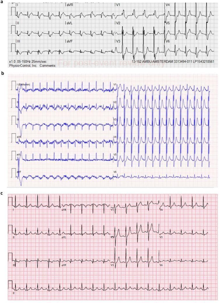 This diagnostic image series presents three successive 12-lead electrocardiograms (ECGs) documenting the evolution of cardiac rhythm and repolarization in a clinical case. Panel A displays a baseline ECG showing a sinus rhythm with prominent ST-segment depressions, most notable in the precordial leads V3 through V5, suggesting acute subendocardial ischemia or NSTEMI. Panel B illustrates a subsequent tracing characterized by a rapid supraventricular tachycardia, showing frequent QRS complexes and persistent baseline oscillations. Panel C demonstrates a follow-up ECG where the rhythm has returned to sinus tachycardia with a partial resolution of the previous ST-segment abnormalities, although minor depressions remain visible in the anterior leads. These images are essential for teaching the interpretation of dynamic ECG changes associated with acute coronary syndromes and tachycardia-induced ischemia in an emergency or critical care setting.