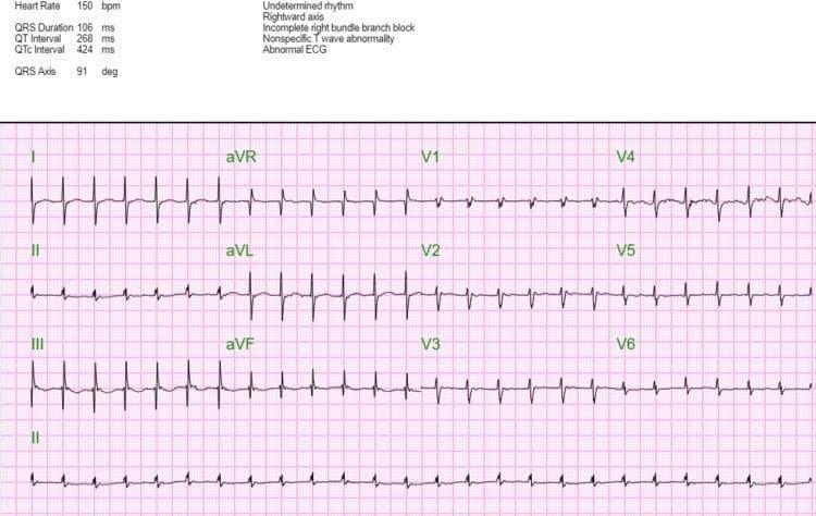 A 12-lead diagnostic electrocardiogram (ECG) demonstrating supraventricular tachycardia (SVT) with a heart rate of 150-151 beats per minute. The rhythm exhibits a regular tachycardia with narrow QRS complexes, although a right bundle branch block (RBBB) morphology is present, particularly visible as an RSR' pattern in the precordial leads V1-V3. Numerical data on the tracing indicates a QRS duration of 106 ms, a QT interval of 268 ms, and a QTc of 424 ms. A rightward axis of approximately 91 degrees is noted. Secondary findings include non-specific T-wave abnormalities across multiple leads, characterized by flattening or slight inversion. The image includes both standard limb leads (I, II, III), augmented limb leads (aVR, aVL, aVF), and precordial leads (V1-V6), plus a rhythm strip from lead II. This ECG provides a classic clinical representation of SVT combined with conduction system delays, serving as an educational tool for identifying tachyarrhythmias and morphological variations in cardiac electrical activity.