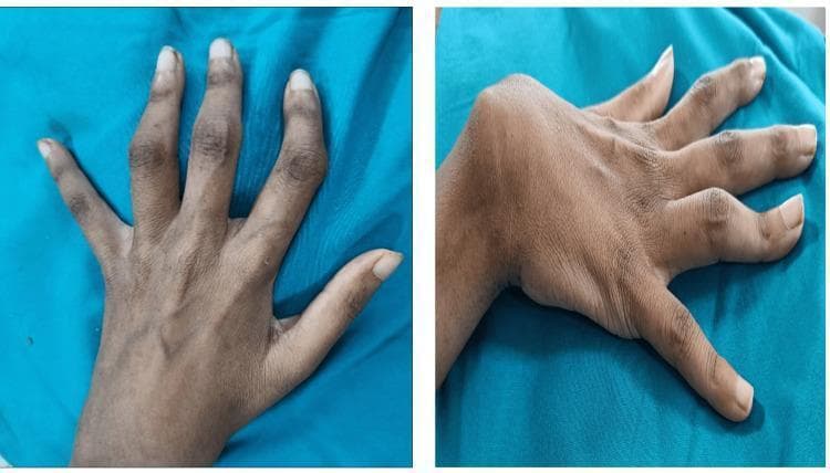 Clinical photograph showing bilateral hand and wrist deformities in a patient with chronic inflammatory arthritis. The left hand (dorsal view) exhibits classic boutonniere deformities of the index and middle fingers, characterized by flexion at the proximal interphalangeal (PIP) joints and hyperextension at the distal interphalangeal (DIP) joints. The left index finger also demonstrates significant radial deviation at the PIP joint level. The right hand (lateral-dorsal view) displays a boutonniere deformity of the ring finger and a prominent ulnar subluxation of the wrist joint, appearing as a volar and ulnar displacement of the carpus relative to the distal radius and ulna. These findings are representative of advanced joint destruction and ligamentous laxity often seen in systemic autoimmune conditions like seronegative arthritis or rheumatoid arthritis. The image serves as an educational reference for identifying characteristic musculoskeletal manifestations of systemic inflammatory diseases in the small joints of the hand.