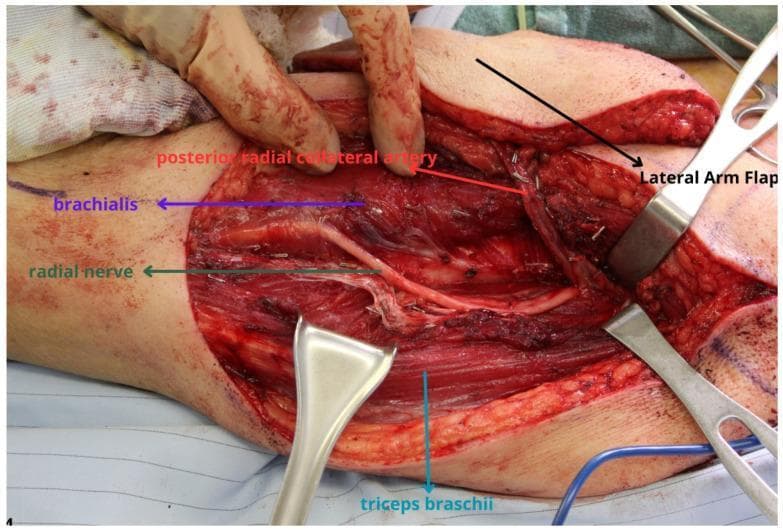 This clinical photograph shows an intraoperative view of a lateral arm flap harvest, highlighting critical neurovascular anatomy of the upper extremity. The surgical field displays the dissection of a fasciocutaneous flap, with a metal retractor reflecting the 'Lateral Arm Flap' to expose the underlying muscular and neurovascular structures. Key landmarks identified by color-coded labels include the radial nerve, which is seen coursing through the spiral groove region between the brachialis muscle (superior/anterior) and the triceps brachii muscle (inferior/posterior). The posterior radial collateral artery, a branch of the profunda brachii and the primary vascular pedicle for this flap, is shown in close proximity to the radial nerve. The image illustrates the surgical plane and the delicate relationship between the radial nerve and the vascular pedicle, emphasizing the clinical importance of nerve protection during flap elevation. This material is intended for advanced surgical education in reconstructive plastic surgery and microsurgery.