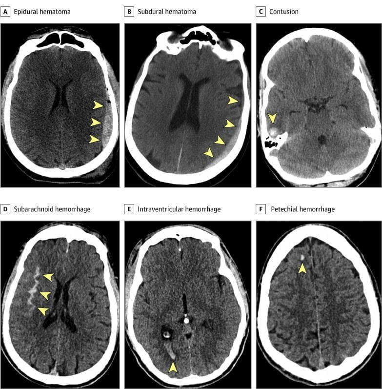 This composite educational graphic presents six axial noncontrast computed tomography (CT) scans of the brain, demonstrating common subtypes of acute traumatic intracranial hemorrhage (ICH) as defined by the NINDS Common Data Elements. Panel A shows an Epidural Hematoma (EDH) characterized by a high-density, biconvex (lens-shaped) collection between the skull and dura mater. Panel B illustrates a Subdural Hematoma (SDH) as a crescent-shaped hyperdensity along the brain surface. Panel C demonstrates a Cerebral Contusion, appearing as a heterogeneous intraparenchymal lesion with mixed densities. Panel D shows a Subarachnoid Hemorrhage (SAH) with hyperdense blood filling the cortical sulci and fissures. Panel E displays an Intraventricular Hemorrhage (IVH) with high-density blood layering within the posterior horns of the lateral ventricles. Panel F identifies a Petechial Hemorrhage, seen as a small, punctate focus of high density within the white matter, often associated with diffuse axonal injury. Yellow arrowheads highlight the specific pathologies in each diagnostic image, emphasizing the distinct morphology and anatomical compartmentalization of each bleed type.