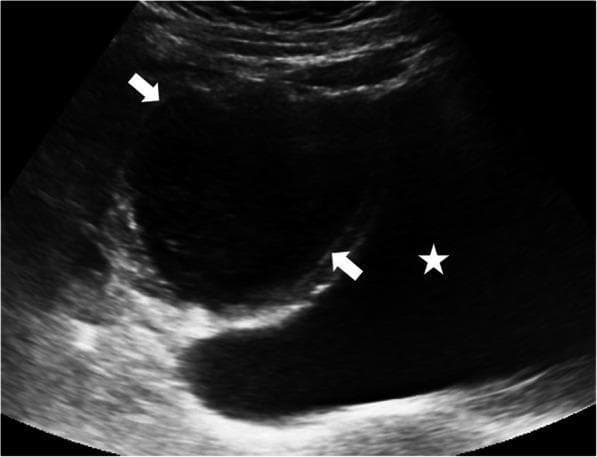 This diagnostic ultrasound image presents a sagittal view of the pelvic region in a pediatric patient. The primary finding is a round-shaped cystic lesion, demarcated by white arrows, situated immediately superior to the bladder. The bladder is identified by a white star and appears as a standard anechoic, fluid-filled structure with well-defined margins. In contrast, the superiorly located cystic lesion exhibits mixed internal echogenicity, characterized by low-level internal echoes and a mildly thickened wall, which differentiates it from a simple, clear cyst. This appearance suggests the presence of debris or proteinaceous material within the fluid. The anatomical position along the midline between the bladder and the umbilicus, combined with the signs of inflammation or infection (mixed echogenicity), is highly characteristic of an infected urachal cyst. The surrounding pelvic soft tissues show a heterogeneous echotexture within normal limits. This visual evidence supports the clinical evaluation of suprapubic pain in a pediatric context and illustrates the diagnostic features of urachal remnants.