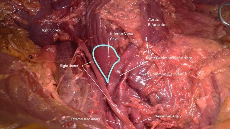 This clinical photograph displays a surgical dissection of the posterior abdominal wall and pelvic vasculature in a male cadaver, illustrating a variant of May-Thurner Syndrome (MTS). The visual focuses on the relationship between the aortic bifurcation and the inferior vena cava (IVC). A prominent right common iliac artery is shown crossing anteriorly over the distal segment of the IVC and the left common iliac vein. A teal outline highlights a pre-stenotic dilation of the inferior vena cava, indicating venous stasis caused by arterial compression. The right common iliac artery exhibits surface dimpling, characteristic of atherosclerotic plaque. Anatomical landmarks include the right kidney, right ureter, external iliac artery, and internal iliac artery. This image serves as an educational demonstration of vascular compression syndromes and anatomical variations in pelvic venous outflow. It is suitable for advanced medical students and surgical residents studying retroperitoneal anatomy and vascular pathology.