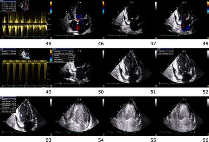 A composite of 12 transthoracic echocardiographic frames and Doppler waveforms documenting the physiological progression toward cardiac standstill during ACLS. The series primarily utilizes apical four-chamber views to demonstrate hemodynamic collapse. Early frames (45-48) show biventricular hypokinesis with color Doppler indicating mitral and tricuspid regurgitation, accompanied by a trace circumferential pericardial effusion. As the sequence progresses through frames 49-53, there is a visible reduction in cardiac wall motion and atrioventricular valve excursion. Starting in frame 54 and intensifying through frame 56, there is an abrupt appearance and rapid progression of dense spontaneous echo contrast (SEC) within the left ventricle, indicative of blood stasis and incipient thrombus formation. The final frames capture the 'dying heart' phenotype, characterized by cessation of mechanical activity, tethered atrioventricular valves with a fixed mid-annular gap, and increasing intracavitary echogenicity across all chambers. This educational series illustrates the echocardiographic correlates of pulseless electrical activity and the transition to cardiac arrest.