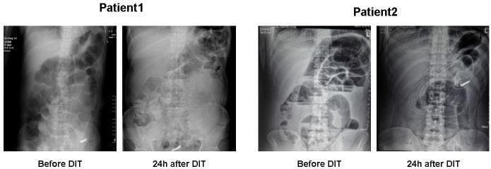 This diagnostic imaging panel consists of four anteroposterior abdominal X-ray plain films comparing two patients (Patient 1 and Patient 2) with acute intestinal obstruction before and 24 hours after a deeper intubation technique (DIT). In the 'Before DIT' images for both patients, there are classic signs of small bowel obstruction, including significant gaseous distension of bowel loops and visible air-fluid levels. In Patient 2, the 'Before DIT' film particularly highlights multiple dilated small bowel loops in a step-ladder pattern. The '24h after DIT' images demonstrate a marked reduction in intestinal gas and decompression of the previously dilated bowel loops. Notably, in the post-procedure film for Patient 2, a radio-opaque intestinal decompression tube is clearly visible, extending through the stomach and deep into the intestinal tract with the distal tip positioned in the lower abdominal quadrant. These images illustrate the radiological progression of bowel decompression and the effective placement of deeper intubation for managing obstructive pathologies.