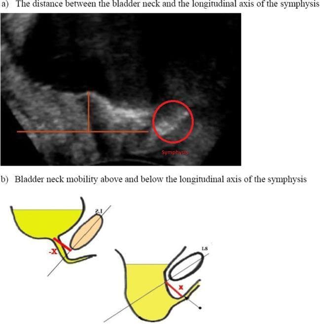 This composite educational graphic illustrates the assessment of bladder neck mobility using transperineal ultrasound. Panel (a) is a diagnostic grayscale ultrasound image in the sagittal plane, showing the pelvic floor anatomy. A red circle highlights the symphysis pubis, which serves as a fixed bony landmark. Red overlaid lines demonstrate the measurement of the vertical distance between the bladder neck and the longitudinal axis of the symphysis. Panel (b) features two comparative schematic diagrams showing different states of bladder neck position relative to the symphysis axis. The diagram on the left shows the bladder neck (yellow) at a higher position relative to the diagonal reference line, indicated as a negative value (-X). The diagram on the right shows the bladder neck descended below the reference line, indicated as a positive value (X). This comparison is clinically relevant for evaluating pelvic organ prolapse and urinary incontinence by measuring bladder neck descent during rest versus a Valsalva maneuver. The visual focus is on the dynamic relationship between the bladder, urethra, and the longitudinal symphyseal axis.