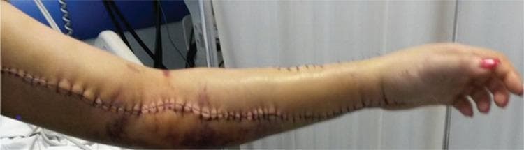 This clinical photograph displays the left upper limb of a patient on the 5th postoperative day following surgical treatment for compartment syndrome secondary to a Crotalinae (pit viper) snakebite. A long, linear fasciotomy incision is visible, extending from the distal upper arm, across the antecubital fossa, and down the length of the anterior forearm to the wrist. The wound is closed with multiple interrupted non-absorbable sutures, showing well-apposed edges with no evidence of dehiscence or purulent discharge. Significant perilesional ecchymosis and bruising are noted, with dark purple and reddish skin discoloration concentrated around the elbow and proximal forearm. The skin appears slightly shiny, suggesting resolving edema. Two small, darkened puncture marks proximal to the elbow likely represent the initial bite site. This image serves as a clinical example of postoperative recovery following emergency surgical decompression and the local dermatologic manifestations of envenomation-induced tissue injury and deep vein thrombosis.