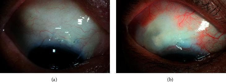 Two side-by-side slit-lamp clinical photographs showing filtering blebs in the superior bulbar conjunctiva following glaucoma surgery (trabeculectomy). Panel (a) displays a post-trabeculectomy bleb with amniotic membrane transplantation (AMT). It exhibits medium height, a horizontal extent of approximately 4 clock-hours, and mild vascularity, characterized by fine, dispersed conjunctival vessels over the elevated area. Panel (b) shows a post-trabeculectomy bleb without AMT. This bleb is also of medium height but has a slightly smaller horizontal extent of approximately 3 clock-hours. It appears cystic and translucent with notable avascularity over the main filtering area, contrasting with the surrounding peripheral conjunctival hypervascularity. These images are used to compare bleb morphology, specifically the Wuerzburg or Moorfields bleb grading parameters, in different surgical techniques for intraocular pressure (IOP) management.