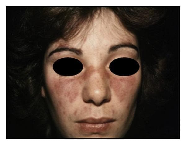 This clinical photograph displays a classic malar rash, also known as a butterfly rash, on a patient's face. The rash is characterized by fixed, erythematous (reddened) macules and plaques distributed symmetrically across the nasal bridge and the malar eminences (cheeks). A key diagnostic feature visible in this image is the sparing of the nasolabial folds, which helps distinguish this clinical sign from other facial eruptions such as seborrheic dermatitis. The texture of the rash appears slightly elevated in some areas, suggesting a papular component alongside the macular erythema. This visual finding is a primary American College of Rheumatology (ACR) criterion for the diagnosis of systemic lupus erythematosus (SLE). The clinical photograph is set against a dark background with the patient's eyes obscured for privacy, focusing clinical attention on the mid-facial cutaneous manifestations of autoimmune connective tissue disease.