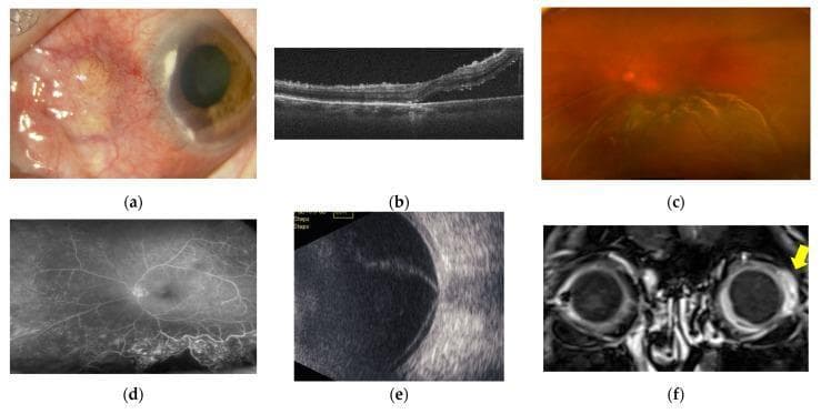 A multi-modal diagnostic panel illustrating anterior and posterior scleritis in a human eye. (a) Clinical photograph of the anterior segment showing hyperemic necrotizing scleritis and corneal marginal infiltration. (b) Optical Coherence Tomography (OCT) cross-section demonstrating a raised, wrinkled neuroepithelial layer with subretinal fluid accumulation. (c) Color fundus image depicting papilledema and extensive serous retinal detachment (SRD) involving the macula. (d) Fundus Fluorescein Angiography (FFA) highlighting retinal vasculitis and leakage consistent with SRD. (e) B-mode ultrasonography showing characteristic 'T-sign' (posterior scleral edema) and scleral thickening associated with extensive SRD. (f) Contrast-enhanced MRI (coronal view) revealing significant contrast enhancement localized to the posterior ocular wall (yellow arrow). This composite illustrates the typical progression and diagnostic findings for combined anterior and posterior inflammatory eye disease, highlighting key clinical features such as scleral melting, subretinal fluid, and optic disc swelling.