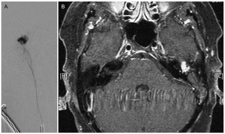 This dual-panel image displays diagnostic modalities for a Glomus tympanicum paraganglioma in a patient with pulsatile tinnitus. Panel A is a superselective Digital Subtraction Angiography (DSA) frame demonstrating a microcatheter positioned within a tortuous feeding vessel. A focal, irregular area of dense contrast opacification (tumor blush) is visible, indicating the hypervascular nature of the lesion prior to embolization. Panel B is an axial contrast-enhanced, fat-saturated T1-weighted Magnetic Resonance Image (ce-T1 fs MRI) of the skull base. It reveals a small, intensely enhancing soft tissue mass located in 'loco typico' within the left middle ear cavity, adjacent to the temporal bone. The mass is hyperintense relative to the surrounding brain parenchyma and musculature. These images illustrate the complementary roles of MRI for anatomical localization and DSA for vascular characterization of glomus tumors.