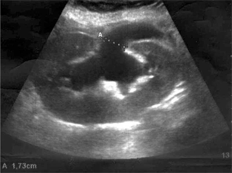 This diagnostic ultrasound image demonstrates a human kidney with signs of severe hydronephrosis. The primary finding is a large, central, anechoic (black) area representing a dilated renal pelvis, from which several elongated anechoic regions radiate outwards, corresponding to dilated renal calyces. This branching configuration creates a typical 'bear paw' or cauliflower-like pattern of pelvicalyceal dilatation. The surrounding renal parenchyma appears relatively hypoechoic and thinned due to the internal pressure of the fluid accumulation. An electronic caliper measurement marked 'A' indicates a transverse diameter of 1.73 cm in the upper portion of the dilated collecting system. The image is clinically significant for illustrating obstructive uropathy, specifically showing how fluid distention distorts the normal renal architecture. It serves as an educational example of graft sonography used to monitor renal transplant complications like acute hydroureteronephrosis.