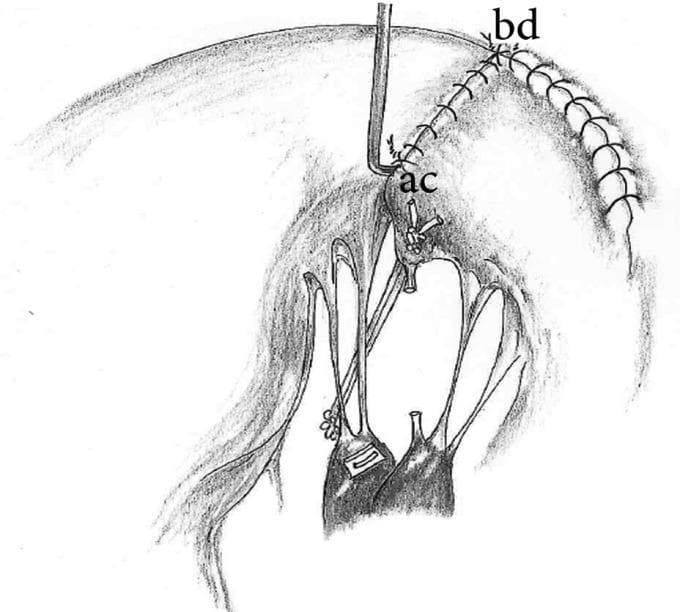 This medical illustration depicts a surgical technique for mitral valve repair, specifically focusing on the reconstruction of the posterior leaflet and subvalvular apparatus. The diagram illustrates a quadrangular resection followed by the reattachment of the posterior leaflet remnants (P2 and P1 segments) to the mitral annulus using a continuous running suture pattern. Interrupted sutures are visible where the P2 remnant (marked 'c-d') is affixed to the commissure remnant (marked 'a-b'). A critical feature shown is the neochordae formation, where an artificial cord (likely PTFE) is anchored from a pledget-reinforced site on the anterior papillary head of the posterior papillary muscle to the free edge of the high P2 remnant. The subvalvular anatomy is clearly represented, including the papillary muscles and native chordae tendineae. This illustration is intended for cardiothoracic surgery education, demonstrating techniques to manage posterior leaflet prolapse while maintaining optimal coaptation and ventricular-mitral continuity.