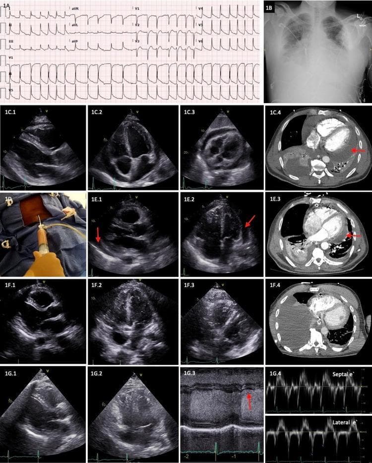 A multi-panel clinical composite illustrating the diagnosis and longitudinal management of purulent pericarditis. Panel A presents a 12-lead ECG showing atrial fibrillation and diffuse ST-segment elevation. Panel B is a frontal chest X-ray displaying cardiomegaly and bilateral interstitial opacities with costophrenic angle blunting. Panels C.1-C.4 (Day 1) show a large circumferential pericardial effusion via transthoracic echocardiography (TTE) in parasternal long-axis, apical 4-chamber, and subcostal views, and an axial CT scan (red arrow). Panel D depicts clinical pericardiocentesis with aspiration of purulent fluid. Panels E.1-E.3 (Day 4) show residual loculated effusion following surgical drainage. Panels F.1-F.4 (Day 8) demonstrate near-complete resolution of the effusion after intrapericardial r-tPA administration. Panels G.1-G.4 represent a 2-year follow-up, using TTE and M-mode (G.3) and Doppler (G.4) imaging to confirm the absence of pericardial effusion or constrictive physiology, such as the absence of early-mid diastolic notching and annulus reversus.