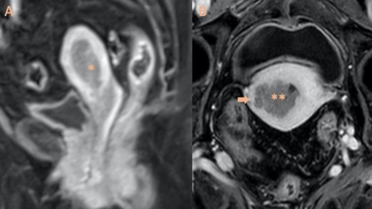This Comparison Chart consists of two contrast-enhanced T1-weighted MRI images demonstrating the staging of endometrioid adenocarcinoma. Image A (left) displays a Sagittal T1-weighted MRI with intravenous gadolinium, showing a Stage IA grade 2 endometrial tumor (marked with a single asterisk) confined within the uterine cavity without significant myometrial invasion. Image B (right) is a contrast-enhanced MRI showing Stage IB grade 3 endometrioid adenocarcinoma (marked with double asterisks). In this advanced stage, the tumor visibly infiltrates into the outer one-half of the myometrium, with the depth of invasion clearly indicated by an arrow. The use of gadolinium contrast facilitates the differentiation between the enhancing tumor tissue and the surrounding myometrium. These diagnostic images are essential for FIGO staging of endometrial cancer, where Stage IA represents less than 50% myometrial invasion and Stage IB represents 50% or greater invasion. The content is designed for intermediate to advanced medical education in gynecology-oncology and radiology.