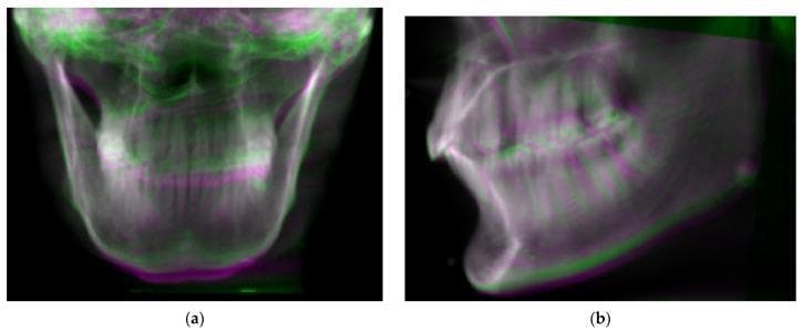 This diagnostic comparison image consists of two panels, (a) frontal and (b) lateral projections, demonstrating simulated Digitally Reconstructed Radiographs (DRRs) derived from Cone Beam Computed Tomography (CBCT) data. The images utilize a color-overlay technique to visualize orientation deviations in a phantom skull model. The green layer represents the skull in its original, baseline orientation, while the magenta layer represents the same volume rotated +/- 6 degrees in the pitch and roll axes. In the frontal view (a), misalignments are visible as color fringes along the mandibular symphysis and cranial borders. The lateral view (b) highlights more pronounced color separation across the dental arcade, nasal bones, and the posterior ramus of the mandible. This visualization is used in dental and maxillofacial radiology to assess the accuracy of image registration algorithms and to evaluate the impact of patient positioning errors on radiographic projections. Key educational concepts include rotational displacement (pitch, roll, yaw), coordinate system alignment, and the clinical significance of reproducibility in maxillofacial imaging.
