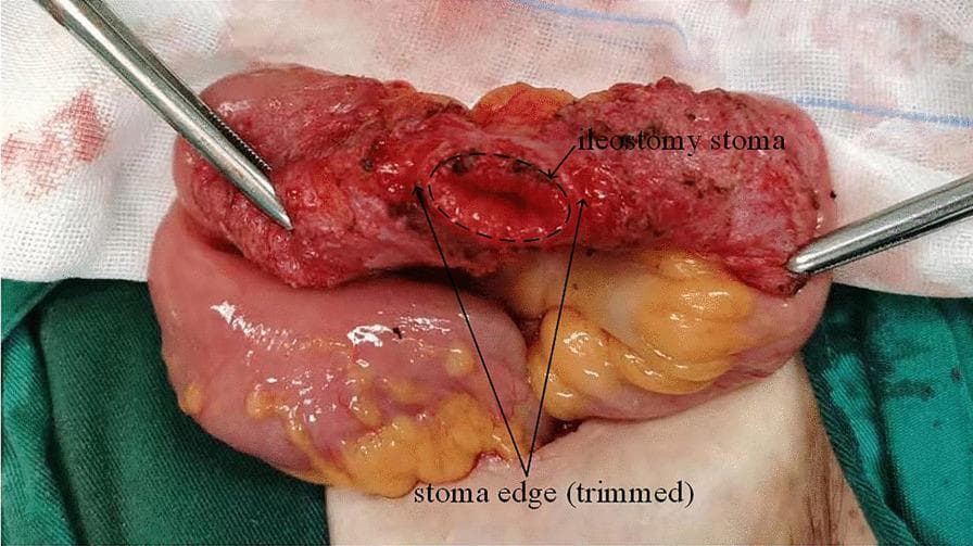 This clinical photograph captures an intraoperative view of an ileostomy stoma revision or reversal procedure. The image depicts a fully mobilized intestinal segment being held taut by two surgical forceps (likely Allis or Babcock clamps). The ileostomy stoma is centrally located on the freed bowel loop, with its edge clearly trimmed to remove adherent skin and scar tissue, exposing the healthy, deep-red mucosal lining. The intestinal wall exhibits a reddish-purple, hyperemic appearance with a granular surface texture, characteristic of stomal tissue. Visible mesenteric fat (yellowish lobulated tissue) is attached to the underside of the bowel loop. The surgical field includes sterile green drapes and white gauze. This visual demonstrates a critical step in stoma preparationβensuring a viable, healthy intestinal wall before resection or anastomosis in colorectal surgery. Key educational concepts include surgical mobilization of the bowel, stoma edge debridement, and assessment of tissue perfusion.