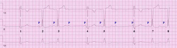Diagnostic electrocardiogram (ECG) rhythm strip displaying leads V1, II, and V5, demonstrating a complex conduction disturbance involving alternating bundle branch block morphologies and atrioventricular (AV) block. The tracing shows eight numbered QRS complexes. Complexes 2, 3, 5, 7, and 8 exhibit a wide QRS morphology characteristic of Left Bundle Branch Block (LBBB), associated with visible preceding P waves (labeled 'P') and a first-degree AV block. Conversely, complexes 1, 4, and 6 demonstrate a Right Bundle Branch Block (RBBB) morphology. Notably, complex 1 lacks a preceding P wave, and the PR intervals for complexes 4 and 6 are significantly shorter than those of the LBBB complexes, suggesting that the RBBB morphology represents ventricular escape beats in the setting of high-grade or complete AV conduction block. This visual evidence is critical for teaching the identification of advanced infra-nodal conduction system disease and the differentiation between conducted beats and escape rhythms in the presence of bi-fascicular or trifascicular block.
