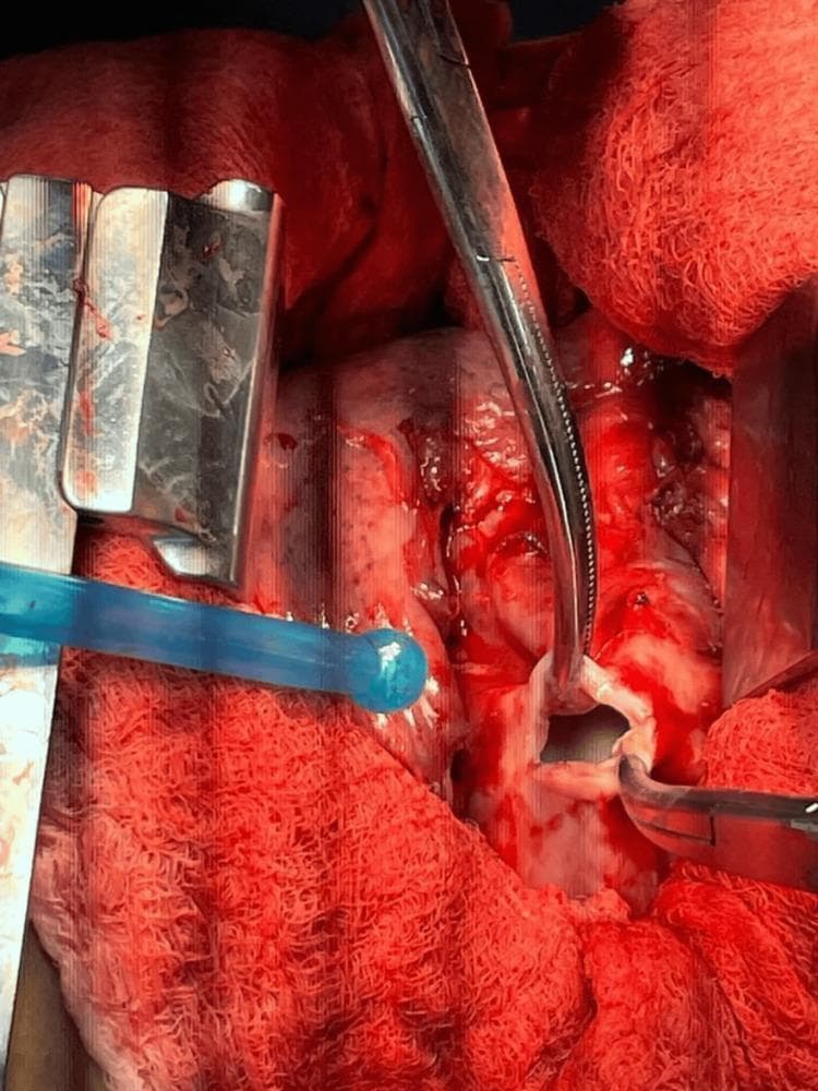 This clinical photograph shows an intraoperative surgical field during a right posterolateral thoracotomy for the treatment of pulmonary hydatid disease. The image captures the drainage and excision of a pulmonary hydatid cyst. A small incision has been made into the white, fibrous cyst wall, through which clear, 'rock water' fluid is draining. Surgical instruments, including a retractor to expose the thoracic cavity and forceps or surgical clamps to secure the cyst wall edges, are visible. The surrounding lung tissue is hyperemic and erythematous, indicating acute inflammation and compression. Red surgical drapes and gauze surround the operative site. A blue suction tip is present in the field to manage fluid drainage and maintain visualization. The procedure illustrates the surgical management of Echinococcus granulosus infection, specifically focusing on controlled cyst decompression to prevent anaphylaxis and daughter cyst spillage before total pericystectomy or lobectomy.
