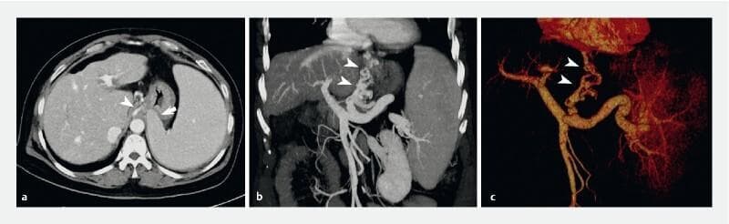 Diagnostic imaging panel displaying computed tomography (CT) venography of the portal venous system in a patient with decompensated cirrhosis. Panel (a) is an axial CT slice showing massive splenomegaly with the enlarged spleen causing significant extraluminal compression of the gastric fundus (indicated by arrow). Panel (b) is a coronal reformatted image, and panel (c) is a 3D volume-rendered reconstruction highlighting the portal vascular anatomy. Arrowheads in all images delineate extensive esophageal varices that extend inferiorly past the cardia and along the lesser curvature of the stomach. Notably, the vascular imaging differentiates these varices from the splenic compression of the fundus, which can mimic fundal varices on endoscopy. This clinical finding is characteristic of GOV1 (gastroesophageal varices type 1). The images illustrate secondary signs of portal hypertension, including splenomegaly and collateral portosystemic circulation, essential for pre-endoscopic procedural planning and diagnostic clarification of gastric wall protrusions.