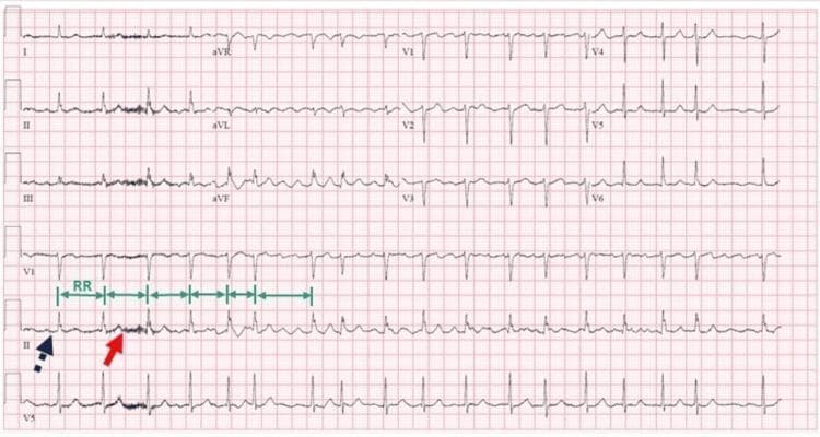This diagnostic image is a 12-lead electrocardiogram (ECG) printed on standard grid paper, demonstrating classic features of atrial fibrillation. The tracing shows a rhythm characterized by 'irregularly irregular' R-R intervals, which are explicitly marked with green bidirectional arrows in the rhythm strip to highlight the variability in heart rate. A defining feature of this ECG is the complete absence of organized P waves preceding the QRS complexes. Instead, the baseline exhibits fibrillatory waves—small, rapid, and irregular oscillations—most clearly visible in the rhythm strip of Lead II (indicated by a solid red arrow) and Lead V1. The purple dashed arrow highlights the flat or undulating baseline where a P wave would normally be expected in sinus rhythm. The QRS complexes appear narrow, suggesting normal ventricular conduction despite the supraventricular arrhythmia. This visual material is a primary educational resource for cardiology and internal medicine, illustrating the fundamental diagnostic criteria for atrial fibrillation.