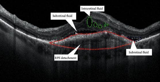 This diagnostic image is a B-scan spectral-domain optical coherence tomography (OCT) of the macula, demonstrating the hallmark signs of exudative (neovascular) age-related macular degeneration (nAMD). The cross-sectional view shows three distinct types of fluid accumulation. First, intraretinal fluid (IRC) is visible as hyporeflective cystoid spaces within the inner retinal layers, outlined by green dashed circles. Second, subretinal fluid (SRF) is present as hyporeflective pockets between the neurosensory retina and the retinal pigment epithelium (RPE), indicated by white arrows. Third, a prominent serous pigment epithelial detachment (PED) is highlighted by a red dashed outline, showing the elevation of the hyperreflective RPE band away from the underlying Bruch's membrane due to sub-RPE fluid. The image illustrates the complex fluid distribution common in type 1 and type 2 macular neovascularization, emphasizing the structural disruption of the retinal layers and the RPE-choriocapillaris complex.