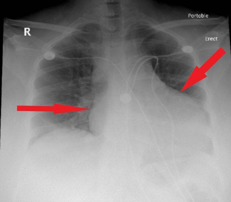 A posteroanterior (PA) view portable chest X-ray demonstrating a significantly enlarged cardiac silhouette, often described as a 'water-bottle' heart shape. Red arrows point to the widened lateral margins of the mediastinum/heart, which obscure the bilateral lung hila. Despite the massive cardiomegaly, the peripheral lung fields remain relatively clear without overt signs of pulmonary edema, vascular congestion, or consolidation. The costophrenic angles are partially visualized, and the trachea appears midline. Multiple external monitoring electrodes and wires are visible on the patient's chest. This radiographic presentation is highly characteristic of a large pericardial effusion, as the rapid accumulation of fluid expands the pericardial sac symmetrically, causing a globular enlargement of the cardiac shadow that masks underlying pulmonary structures.