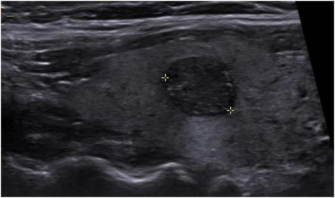 This grayscale ultrasound image of the neck displays a longitudinal view of the right thyroid lobe. A focal, well-defined solid nodule is demarcated by two yellow electronic calipers (crosshairs) representing its maximal diameter. The nodule exhibits a heterogeneous, predominantly hypoechoic echotexture compared to the adjacent normal thyroid parenchyma, which appears more echogenic and uniform. The lesion displays relatively smooth margins and lacks significant cystic components or macrocalcifications in this plane of view. Clinically, such findings in the context of a solid thyroid mass require further risk stratification, such as the TI-RADS (Thyroid Imaging Reporting and Data System) classification, to determine the necessity of fine-needle aspiration (FNA) biopsy for excluding papillary thyroid carcinoma or other malignancies. This diagnostic image serves as an educational example of thyroid sonography used to evaluate incidental nodules or those identified via PET-CT imaging.