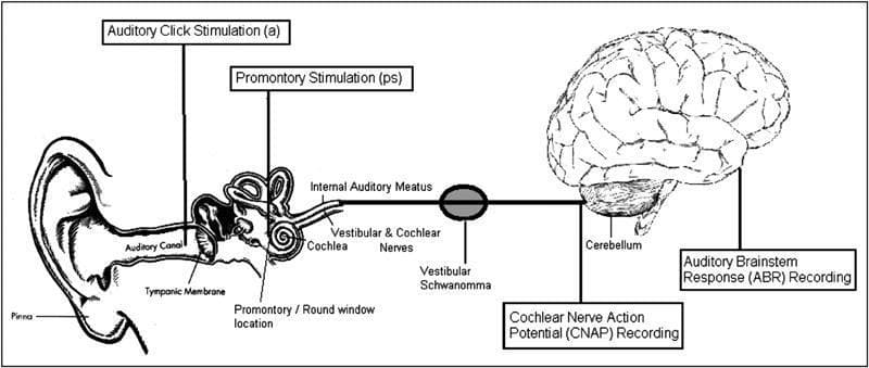 A simplified medical schematic diagram of the human auditory pathway, illustrating key anatomical structures and neurophysiological monitoring sites relevant to vestibular schwannoma surgery. The diagram maps the pathway from the external ear (pinna and auditory canal) to the brain. Labeled structures include the tympanic membrane, promontory/round window location, cochlea, internal auditory meatus, and the vestibular and cochlear nerves. A vestibular schwannoma (acoustic neuroma) is depicted as a mass compressing the auditory nerve. The central nervous system components shown include the cerebellum and the brain. The diagram highlights two stimulation points: 'Auditory Click Stimulation' (acoustic) and 'Promontory Stimulation' (electrical). It also identifies two recording sites for intraoperative neuromonitoring: 'Cochlear Nerve Action Potential (CNAP) Recording' at the level of the cochlear nerve and 'Auditory Brainstem Response (ABR) Recording' at the brainstem level. This illustration serves as an educational guide for understanding the logic behind different auditory monitoring techniques used to preserve hearing during neurosurgical procedures.