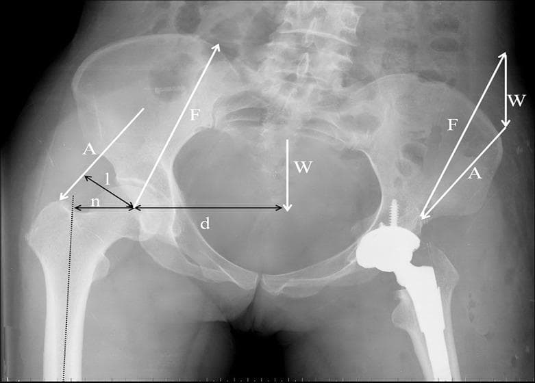 Anteroposterior (AP) radiograph of a human pelvis and both hips demonstrating biomechanical force vectors and lever arms. The right hip (image left) shows native anatomy, while the left hip (image right) features a total hip arthroplasty (THA) with a visible femoral stem and acetabular component. Overlaid on the native hip, white arrows represent the abductor muscle force (A) and the joint reaction force (F). A downward arrow (W) at the pelvic midline represents the body's gravitational force. On the native side, specific measurements are annotated: 'n' (femoral offset) indicates the horizontal distance between the femoral longitudinal axis and the center of rotation; 'l' represents the abductor muscle moment arm; and 'd' represents the gravitational force moment arm extending from the hip center to the midline. The diagram illustrates the equilibrium of forces required for a single-leg stance, highlighting how femoral anatomy and prosthetic placement influence the mechanical advantage of the abductor muscles and the resulting joint reaction forces.