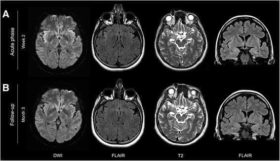 Comparative MRI neuroimaging panel showing brain evolution in a patient with anti-NMDA receptor encephalitis between the acute phase (week 2) and follow-up (month 3). The top row (A) demonstrates bilateral diffusion restriction on Diffusion-Weighted Imaging (DWI) and hyperintensity on axial and coronal Fluid-Attenuated Inversion Recovery (FLAIR) images within the insular cortex, with right-sided predominance. Slight T2 and FLAIR hyperintensities are also visible in both hippocampi. The bottom row (B) illustrates the follow-up phase where the insular diffusion restriction and FLAIR signal abnormalities have completely resolved. However, persistent hyperintensity remains visible in the bilateral hippocampi on both T2-weighted and FLAIR sequences. This diagnostic image sequence highlights the typical limbic involvement and dynamic cortical changes associated with autoimmune encephalitis, emphasizing the differentiation between transient cortical findings and potentially more permanent hippocampal signal changes.