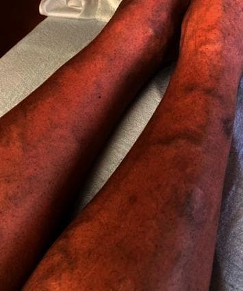 This clinical photograph shows the bilateral lower extremities of a 47-year-old male presenting with a diffuse dermatologic manifestation of thrombocytopenia. The skin demonstrates widespread, non-blanching petechiae, appearing as numerous pinpoint-sized (1-2 mm), reddish-purple macules. These lesions are densely scattered across the anterior and lateral aspects of the shins and calves. In addition to the petechial rash, several larger, coalescent purpuric lesions and subtle ecchymoses are visible, indicating small-vessel bleeding into the dermis. The background skin exhibits generalized erythema. This visual finding is characteristic of severe thrombocytopenia, in this clinical context associated with a viral hemorrhagic fever such as dengue. The image serves as an educational example of the cutaneous signs of low platelet counts and the systemic progression of infectious diseases like dengue fever in a hospital setting.