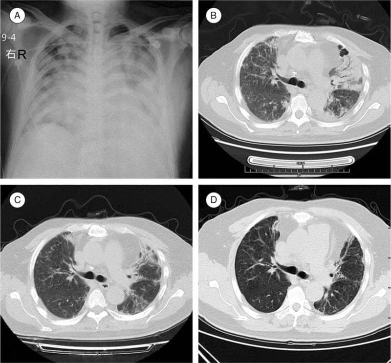 This composite figure presents a longitudinal imaging study of a patient with severe pulmonary infection and ARDS, likely due to H7N9 influenza. (A) Anteroposterior chest X-ray at admission shows diffuse, bilateral alveolar infiltrates and ground-glass opacities, consistent with widespread inflammation. (B) Axial chest CT at admission demonstrates extensive bilateral consolidation, ground-glass opacities, and early fibrotic changes; surgical clips and a mechanical valve reflect a history of cardiac surgery. (C) Follow-up axial CT at discharge shows significant interval resolution of consolidations, though persistent reticular opacities suggest moderate residual fibrosis and chronic inflammation. (D) A 1-year follow-up axial CT reveals stable, irreversible fibrotic changes, architectural distortion, and signs of chronic lung injury. The sequence illustrates the progression and partial resolution of severe viral pneumonia, highlighting the transition from acute exudative inflammation to chronic pulmonary fibrosis and long-term structural sequelae in a post-surgical cardiac patient.