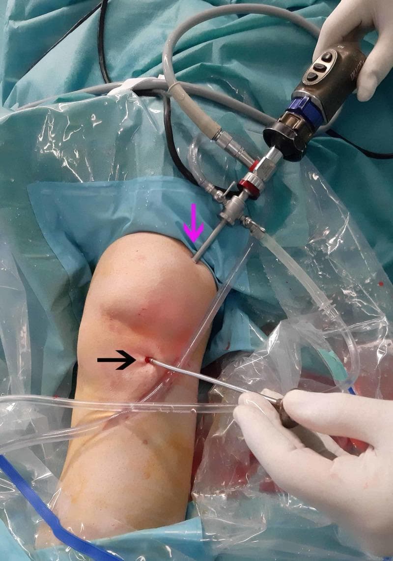 Clinical photograph of a left knee during an orthopedic arthroscopic procedure, highlighting surgical portal placement. The image displays two primary entry points: a superolateral portal (indicated by a pink arrow) and an anterolateral portal (indicated by a black arrow). An arthroscope with attached camera cables and irrigation tubing is inserted into the superolateral portal for intra-articular visualization. A metallic blunt trocar, held by a gloved hand, is inserted through the anterolateral portal for joint manipulation. The surgical field is prepared with sterile blue drapes and clear plastic adhesive drapes (incise drapes). The skin shows mild erythema localized around the puncture sites, consistent with acute surgical access. This image demonstrates the standard triangulation technique used in knee arthroscopy to evaluate intra-articular pathology, such as meniscus tears or localized masses, by utilizing one portal for visualization and another for instrumentation.