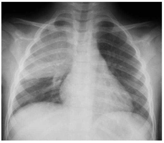 Anteroposterior (AP) pediatric chest radiograph demonstrating a prominent, dense opacity in the right upper and middle lung zones. The finding is consistent with lobar consolidation, showing an ill-defined superior border and a relatively sharp inferior margin at the horizontal fissure. The presence of air bronchograms within the opacity indicates alveolar replacement by fluid, inflammatory exudate, or cells, characteristic of bacterial pneumonia. The left lung field remains clear with normal vascular markings. The mediastinal silhouette and cardiac shadow appear within normal limits for a pediatric patient, although the right heart border is partially obscured by the adjacent consolidation (positive silhouette sign). The skeletal structures, including the ribs and clavicles, are intact. This diagnostic image serves as a classic example of community-acquired pneumonia in a child, illustrating the radiographic hallmarks of pulmonary consolidation and its anatomical localization.