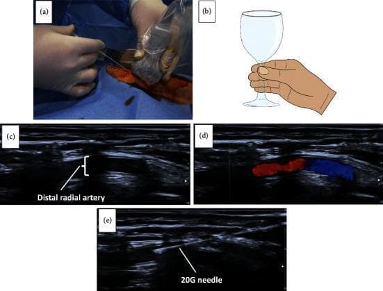 This composite figure illustrates ultrasound-guided distal radial artery (dTRA) puncture, a technique used for coronary angiography or intervention. Panel (a) is a clinical photograph showing the procedural setup with a 20G needle held at a 30-45° angle relative to a sterile-sheathed ultrasound transducer placed on the patient's hand. Panel (b) provides an anatomical diagram illustrating the 'wineglass' grip technique for stable transducer handling. Panels (c), (d), and (e) present diagnostic ultrasound images in the long-axis view. Panel (c) shows the anechoic lumen of the distal radial artery. Panel (d) utilizes Color Doppler imaging to demonstrate arterial blood flow, represented by red and blue signals. Panel (e) depicts the real-time needle advancement, with the 20G needle appearing as a hyperechoic linear structure entering the vessel lumen. The series demonstrates the transition from physical setup to real-time vessel identification and guided vascular access, highlighting the use of long-axis visualization to enhance procedural success and safety in distal transradial access.