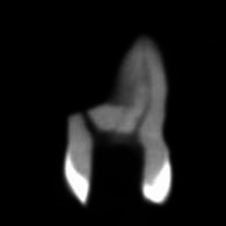 This diagnostic image shows a single-plane slice from a Cone-Beam Computed Tomography (CBCT) scan of a maxillary molar tooth, specifically oriented to evaluate the mesiobuccal root canal system. The visual depicts the tooth crown and two root extensions against a dark, low-density background. There is a clear gradient of radiopacity: the crown and pulp chamber area appear moderately radiopaque (mid-gray), while the apical regions of the roots exhibit high radiopacity (bright white), suggesting a focus on endodontic landmarks or the presence of dense tissue/materials at the apex. The image illustrates the internal anatomy of the tooth, including the transition from the coronal pulp chamber to the cervical and middle thirds of the root. Clinically, this CBCT slice is used in endodontics for lateral canal evaluation, identifying canal morphology based on Vertucci’s classification, and assessing apical anatomy for treatment planning or research into root canal complexities.