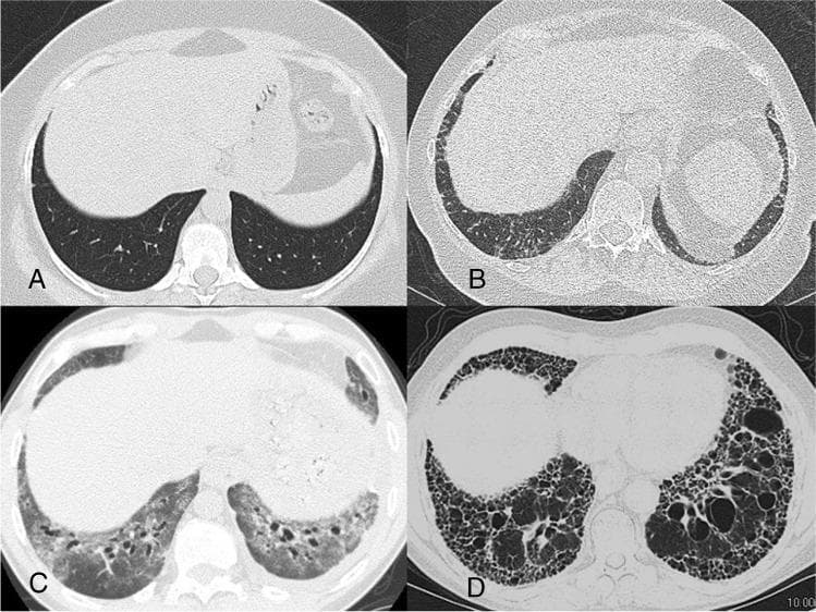 This composite diagnostic image features four axial High-Resolution Computed Tomography (HRCT) scans of the lung bases, illustrating various manifestations of Interstitial Lung Disease (ILD) commonly associated with Systemic Sclerosis (SSc).