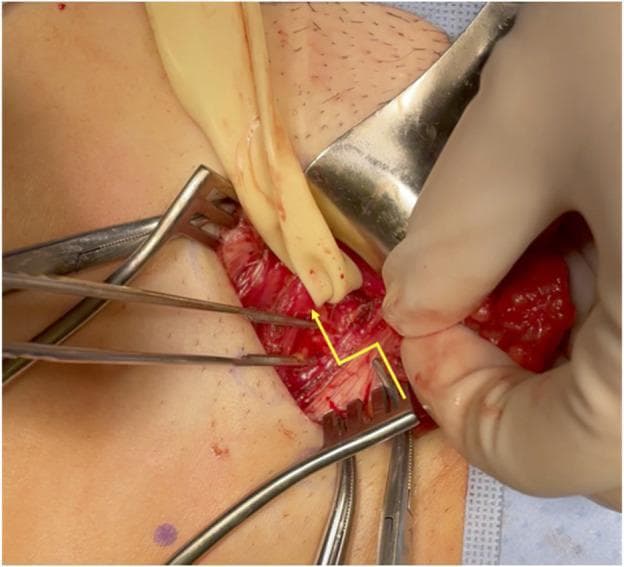 This clinical intraoperative photograph illustrates an open surgical repair of a femoral hernia, focusing on the releasing incision of the inguinal ligament. The surgical field is exposed using multiple instruments, including a metal retractor to pull back the superior tissue layer and two rake-style retractors maintaining lateral exposure. A gloved hand and surgical forceps are seen manipulating the dissected tissue. A yellow line is superimposed on the anatomy to indicate the precise path of the releasing incision through the inguinal ligament, which serves as the roof of the femoral canal. This maneuver is performed to reduce the tension on incarcerated or strangulated visceral contents, allowing for their safe reduction back into the peritoneal cavity. A Penrose drain or similar elastic loop is visible, likely used for traction on the spermatic cord or surrounding structures to improve visualization of the myopectineal orifice. The image demonstrates key landmarks for groin anatomy and the surgical management of strangulated hernias in a clinical setting.