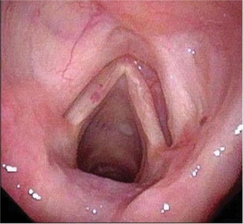 This endoscopic clinical photograph depicts the internal anatomy of the human larynx as captured via electronic video laryngoscopy. The visual focuses on the glottis during inspiration, showing the true vocal cords in an abducted position, forming a V-shaped aperture that reveals the subglottic space. The vocal cords exhibit a normal pearly-white to pale-pink mucosal color with a smooth surface, free of visible nodules, polyps, or leukoplakia. Surrounding supraglottic structures, including the aryepiglottic folds and the ventricular zone (false vocal cords), appear symmetrical with healthy pink mucosa. There is no evidence of edema, erythema, or residual tumor mass in this 9-month postoperative view. The image serves as a representative example of a healthy laryngeal recovery following the surgical resection of an extramedullary plasmacytoma (EMP), demonstrating restored anatomical integrity and no signs of clinical recurrence.