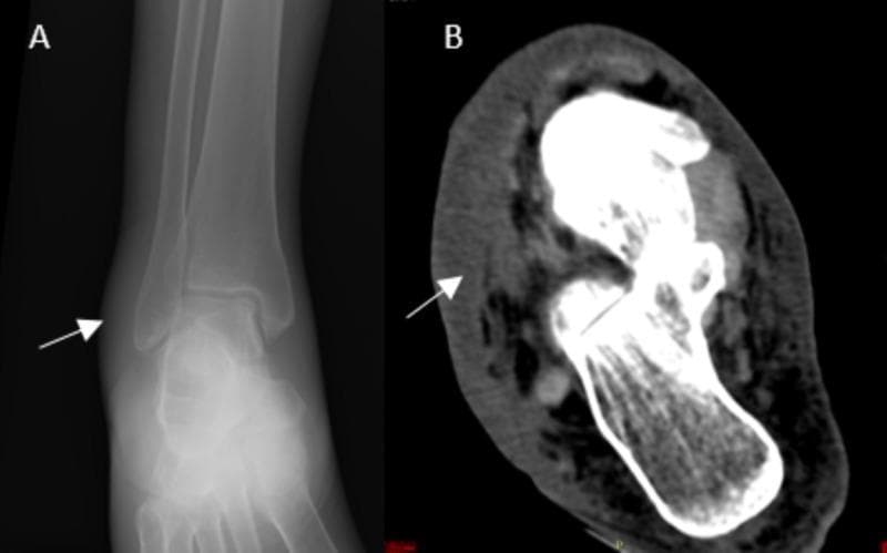 This composite diagnostic image displays a comparison between a conventional radiograph (A) and a computed tomography (CT) scan (B) of a right foot, focusing on the ankle and hindfoot region. Panel A is an anteroposterior X-ray showing marked soft tissue swelling adjacent to the lateral malleolus (indicated by a white arrow), with no evidence of acute fracture, periosteal reaction, or bony erosions. Panel B is an axial CT slice demonstrating high-resolution detail of the same region; it reveals significant subcutaneous edema, skin thickening, and inflammatory fluid infiltration within the soft tissues (arrow). The CT scan confirms the absence of intra-articular collections, gas (emphysema), or cortical bone involvement. These imaging findings are clinically significant for the assessment of cellulitis or soft tissue infection, highlighting the utility of CT in differentiating soft tissue pathology from primary bone disease in the distal lower extremity.