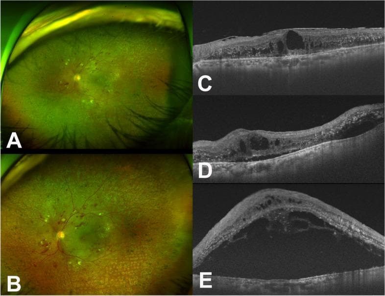 This composite figure displays fundus photography and optical coherence tomography (OCT) of a patient's left eye, illustrating the progression of diabetic retinopathy complicated by syphilitic uveitis. Panels A and B are wide-field fundus photographs showing multiple retinal dot-and-blot hemorrhages, cotton-wool spots, and laser photocoagulation scars. Panel B, taken seven days post-vitrectomy, reveals an increasingly edematous macula compared to the baseline in A. Panels C, D, and E show corresponding OCT cross-sections. Image C (pre-vitrectomy) demonstrates a thickened epiretinal membrane (ERM) and significant intraretinal fluid (IRF) with cystic changes. Image D (post-operative day 1) shows anatomical alterations following ERM peeling. Image E (post-operative day 7) reveals a dramatic progression to massive subretinal fluid (SRF), indicated by a large hyporeflective space beneath the neurosensory retina, which coincided with high VDRL titers. The series illustrates how surgical intervention can trigger or coincide with an acute inflammatory/infectious exacerbation (ocular syphilis) in the setting of existing retinal vascular disease.
