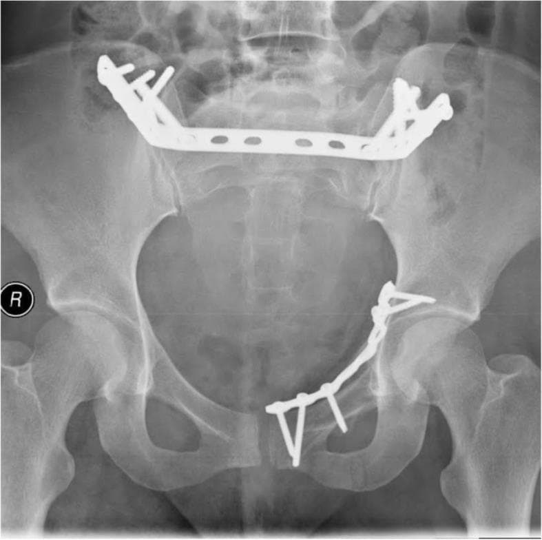 Anteroposterior (AP) pelvic X-ray radiography demonstrating postoperative internal fixation for a complex pelvic ring fracture. The image shows a combination of anterior and posterior stabilization using radiopaque metallic implants. Posteriorly, a transsacral dynamic compression plate (DCP) is visible, positioned horizontally across the sacrum and spanning the sacroiliac joints to bridge the posterior pelvic ring, secured with multiple screws into the iliac wings. Anteriorly, two separate plates are observed: a straight plate spans the superior aspect of the pubic symphysis for transverse stabilization, and a curvilinear reconstruction plate follows the contour of the left inferior pubic ramus, fixed with several orthopedic screws. The imaging highlights surgical management of pelvic instability through multi-planar internal fixation, ensuring the integrity of both the anterior and posterior arcs of the pelvic ring.