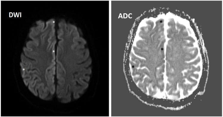 This diagnostic image consists of two axial MRI brain scans side-by-side, displaying Diffusion-Weighted Imaging (DWI) on the left and an Apparent Diffusion Coefficient (ADC) map on the right. The images demonstrate focal areas of true diffusion restriction within the cortical ribbon and sulci of the right frontal and parietal lobes. On the DWI sequence, these areas present as hyperintense (bright) signals, marked with asterisks. Correspondingly, the ADC map shows hypointense (dark) signals in the exact same anatomical locations, confirming restricted diffusion rather than T2 shine-through. This 'cortical ribboning' pattern is a classic radiological finding often associated with rapidly progressive dementias such as Creutzfeldt-Jakob Disease (CJD), or alternatively, acute ischemic stroke or post-ictal states. The visual comparison between the high DWI signal and low ADC signal is essential for identifying cytotoxic edema and abnormal protein deposition in neurodegenerative pathology.