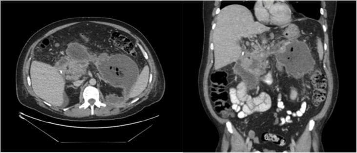 Contrast-enhanced CT scan of the abdomen in axial (left) and coronal (right) planes demonstrating acute necrotizing pancreatitis. The images reveal large, irregular, heterogeneous peripancreatic fluid collections with ill-defined borders involving the pancreatic bed and extending into the retroperitoneum. Within these collections, multiple small, hypodense bubbles of extraluminal gas (air configurations) are clearly visible, particularly in the left-sided collection. This visualization indicates infected pancreatic necrosis. The pancreatic parenchyma shows areas of reduced enhancement and loss of structural integrity, suggesting liquefactive necrosis and breakdown of glandular tissue. The collections lack a thick, enhancing wall, characterizing them as acute necrotic collections (ANC) rather than a walled-off necrosis (WON). This imaging is clinically significant for diagnosing infected necrosis, often requiring surgical or percutaneous drainage and antibiotic therapy.
