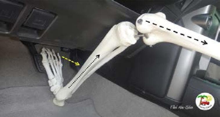 A clinical educational diagram illustrating the biomechanics of lower limb trauma during a frontal-impact motor vehicle collision. The image features a skeletal model of a human lower limb—comprising the femur, tibia, fibula, and foot bones—superimposed within a vehicle's interior. A dashed black arrow indicates the primary mechanism of 'dashboard injury,' where the patella or proximal tibia impacts the dashboard, transmitting axial forces through the femur toward the hip joint, potentially leading to acetabular fractures or posterior hip dislocations. A second dashed yellow arrow highlights the abrupt dorsiflexion and axial loading of the ankle joint caused by forceful application of the brake pedal during impact, a mechanism associated with pilon, talar, and calcaneal fractures. A third dotted black arrow follows the longitudinal axis of the tibia, representing the transmission of energy through the lower leg. The visual serves to educate healthcare professionals on the relationship between occupant posture, vehicle component interface, and specific orthopedic injury patterns in automotive accidents.